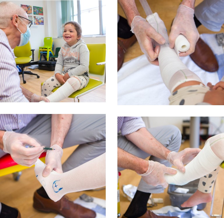 Photo of a ankle foot orthosis being fitted