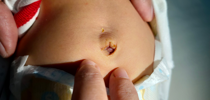 Umbilical Granuloma